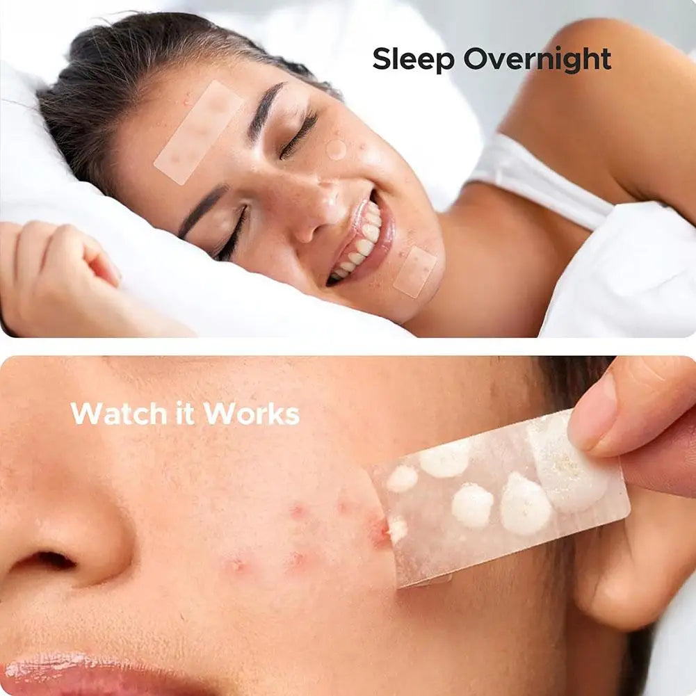 Mixed Sizes Hydrocolloid Pimple Patches Large Hydrocolloid Pimple Patches Invisible Acne Circle Stickers for Zits, Spots, Pimple